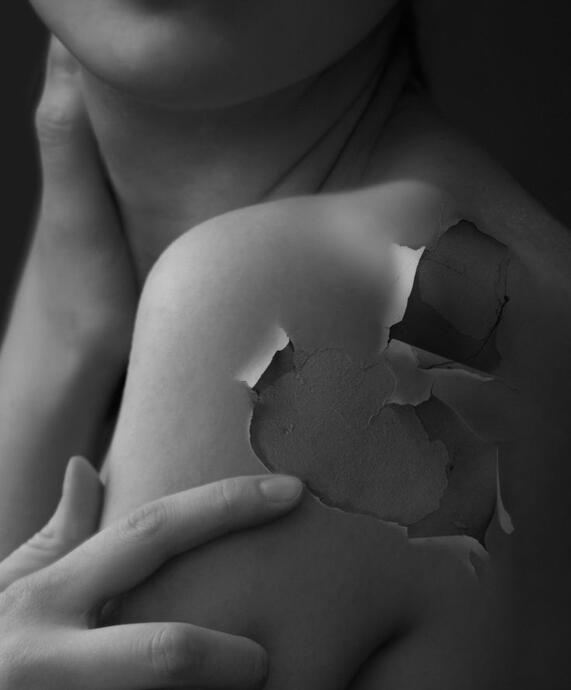 Dermatillomania